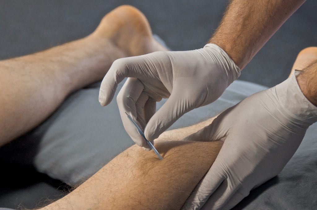 The Role of Dry Needling in Pain Management and Rehabilitation